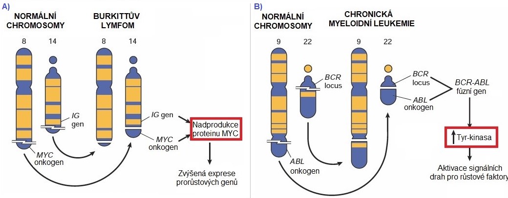 Burkitt%C5%AFv%20lymfom%20a%20Filadelfsk%C3%BD%20chromosom.jpg